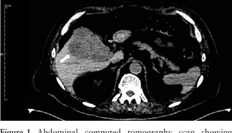 Figure 1 From An Unusual Case Of Cholecystitis And Liver Abscesses In An Older Adult Semantic