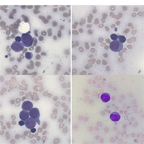 G Banded Metaphase From Bone Marrow Revealed A Karyotype Of