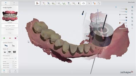 3shape Implant Studio Surgical Guide Youtube