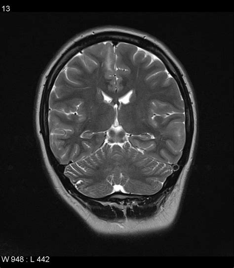 Tuberous Sclerosis Image