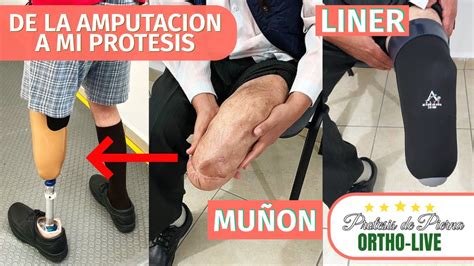 DE LA AMPUTACION A MI PROTESIS TRANSTIBIAL ORTHO LIVE MEXICO YouTube