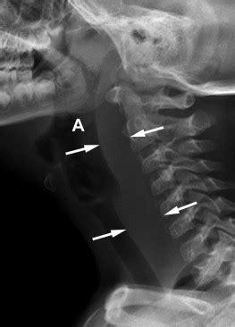 Retropharyngeal Abscess | Radiology Key