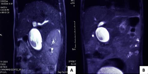 Heterotopic Pancreatic Tissue Associated With Type 1 Choledochal Cyst Cystolithiasis And Gall