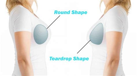 Teardrop Breast Augmentation