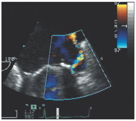 Endocarditis And Other Pathologic And Normal Anatomic Variants Thoracic Key