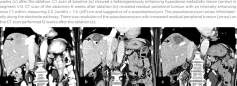 Figure From Spontaneous Resolution Of Asymptomatic Hepatic