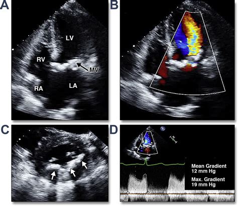 Management Of Mitral Stenosis Using 2d And 3d Echo Doppler Imaging