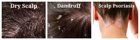 How To Get Rid Of Dandruff