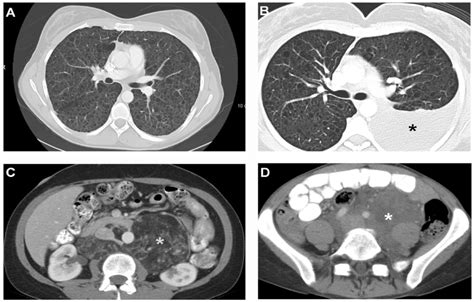 Computed Tomography Scan Images Of Pulmonary And Extrapulmonary