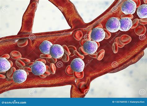 Leucemia Linfoblástica Aguda Stock De Ilustración Ilustración De Linfoma Salud 132766935