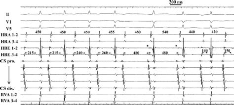 Intracardiac Electrogram Showing Progressive Prolongation And Abrupt