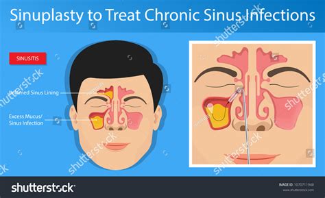 Sinusitis Medical Disease Treat Sinuses Allergies Stock Vector Royalty