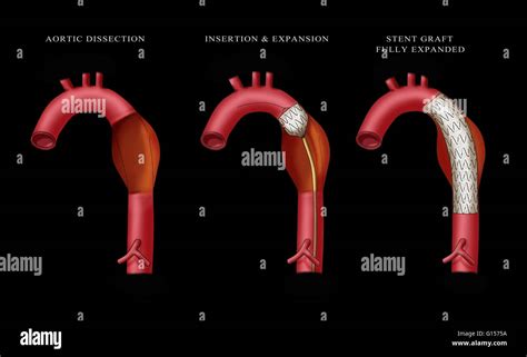 Illustration Depicting Insertion Of An Aortic Aneurysm Stent Far Left Shows Aortic Dissection