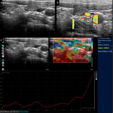 Grayscale A And Color Doppler B Images Of A 42 Year Old Male With