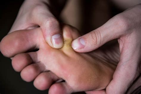 5 remèdes naturels pour soigner les cors aux pieds douloureux La