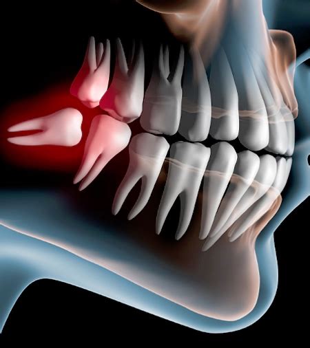 Wisdom Tooth Surgery Cost in Hyderabad, India, FMS DENTAL