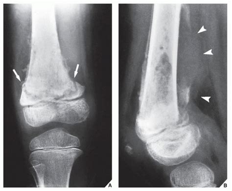 Osteomyelitis X Ray Features