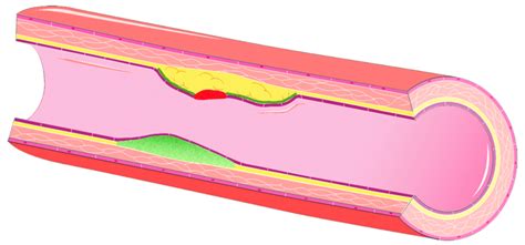 A Schematic Overview Of The VH IVUS Potential Findings On Plaque