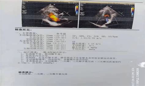 活心丸（浓缩丸）治疗病例之17 冠心病pci术后再发不稳定性心绞痛合并肾功能不全老年患者全民健康网