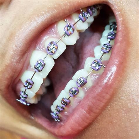 √ Cute Braces Colors For Winter