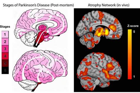 brain mapping parkinson’s disease – Neuroscience News