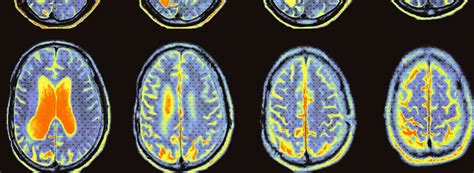 Brain Imaging Interest Group - Faculty of Medicine and Health