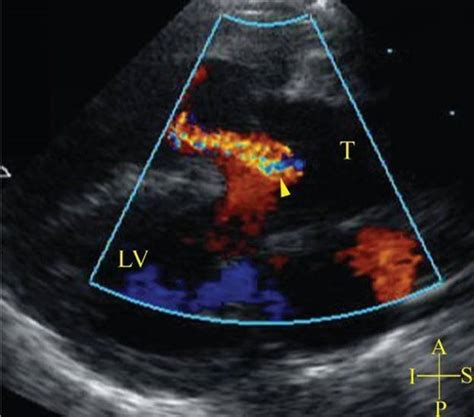 Truncus Arteriosus Echocardiography In Pediatric And Adult Congenital