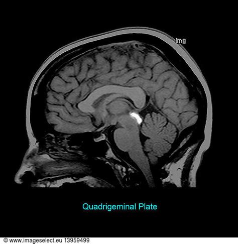 Tectum Tectum Sagittal Mribrain Anatomybrainbrain Region Rights