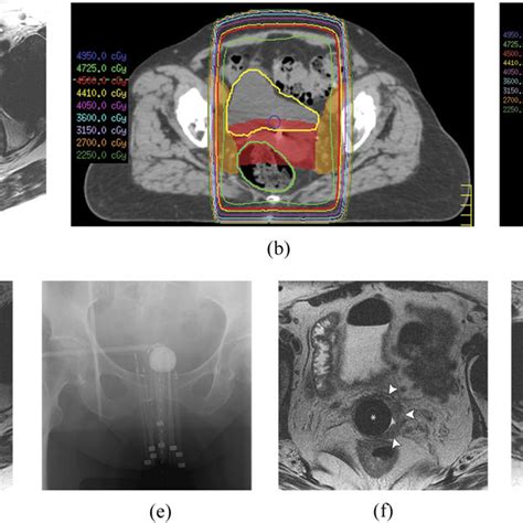 Vaginal Cancer Pelvic Sidewall Involvement A A 45 Year Old Female Download Scientific