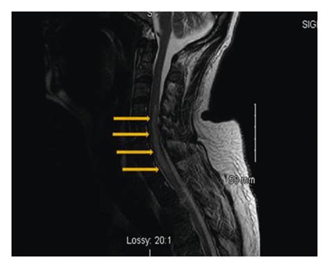 A Sagittal T Weighted MRI Of The C Spine Of The Patient On April 28