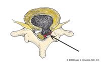 Herniated Disc | Lumbar Spine | Spine Specialist