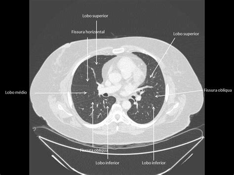 Anatomia Tc De TÓrax