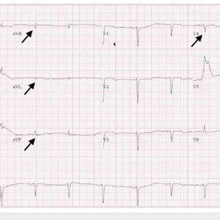 12 leads electrocardiogram (EKG) shows low voltage QRS (black arrows ...