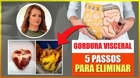 Passos Para Se Livrar Da Gordura Visceral Fa A Isso E Elimine A