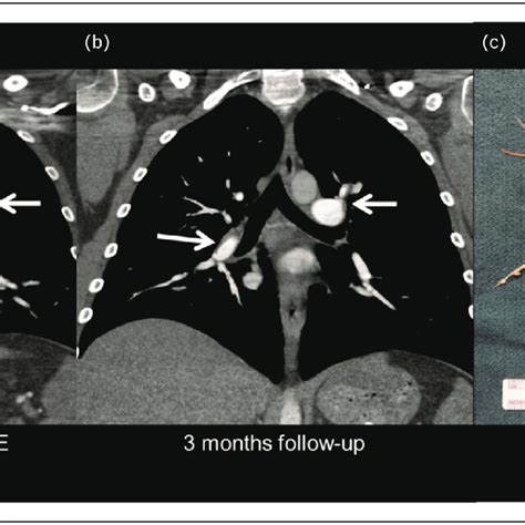 Patients Presenting With Submassive Pulmonary Emboli And Acute On Download Scientific Diagram