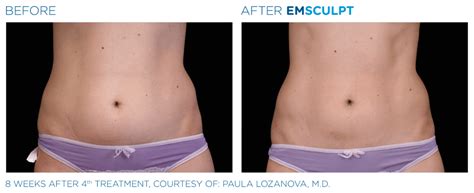 Build The Abs Of Your Dreams With Emsculpt Body Sculpting Atlanta