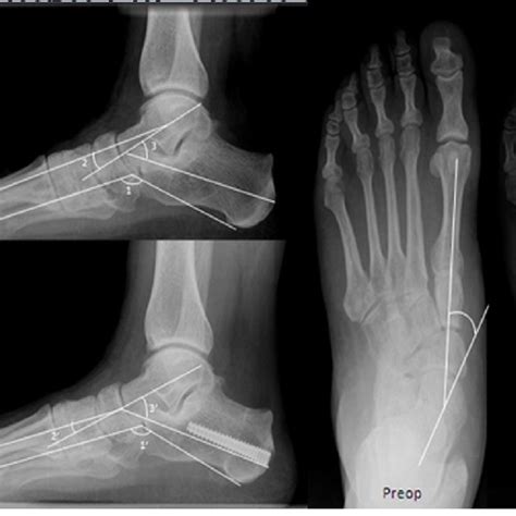 Radiological Lateral View Of An Early Stage Iii Adult Acquired