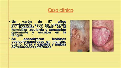 Herpes Z Ster Diseminado Ppt Descarga Gratuita