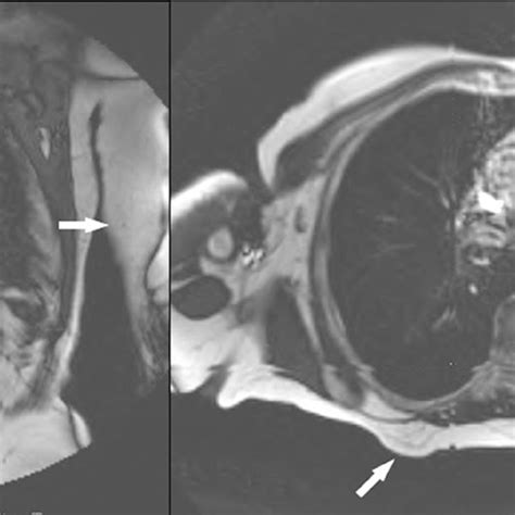 Typical Aspect Of The Patient With Multiple Symmetric Lipomatosis