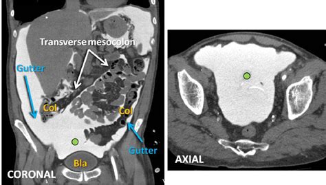 Peritoneal Cavity Anatomy In Ct Peritoneography A Comprehensive