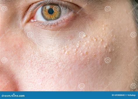 Milia (Milium) - Pimples Around Eye On Skin Royalty-Free Stock Image ...