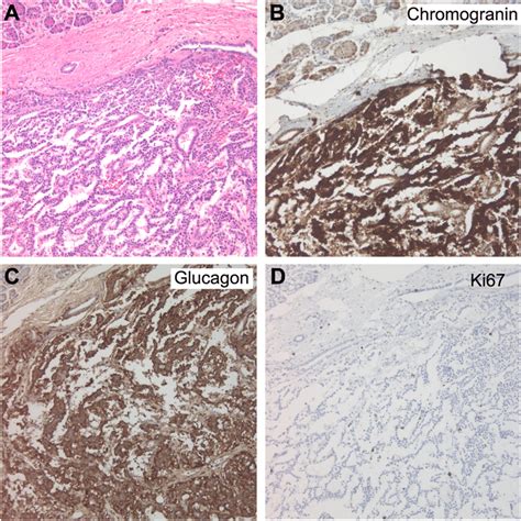 A The Incidental Pancreatic Tail Tumor Composed Of Cords And