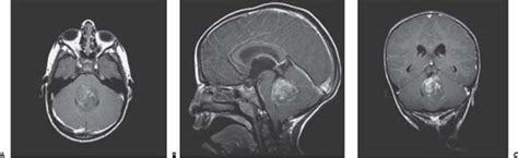 57 Cerebellar Medulloblastoma Neupsy Key