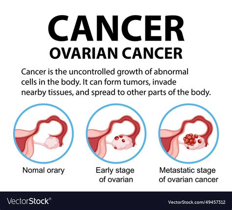 Woman Ovarian Cancer Infographic Stages And Vector Image