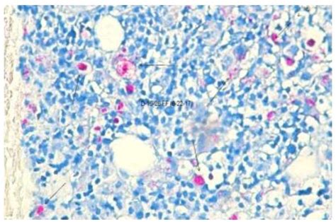 View Of Histopathological Detection Of Mycobacterium Tuberculosis And Mycobacterium Leprae Using