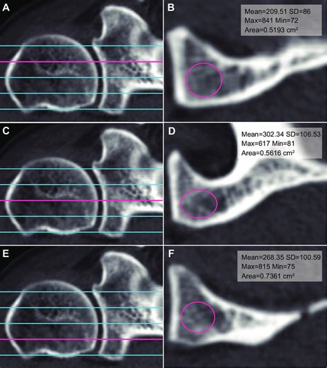 Hounsfield Unit Hu Measurement Technique Of The Glenoid Vault On Download Scientific Diagram