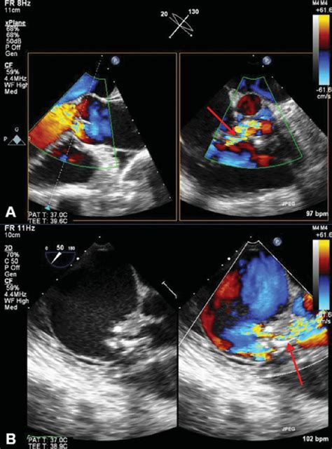 Preoperative Transesophageal Echocardiography A X Plan Long Axis Download Scientific Diagram