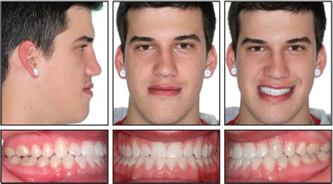 Nonsurgical Correction Of Severe Skeletal Class Iii Malocclusion Jco Online Journal Of