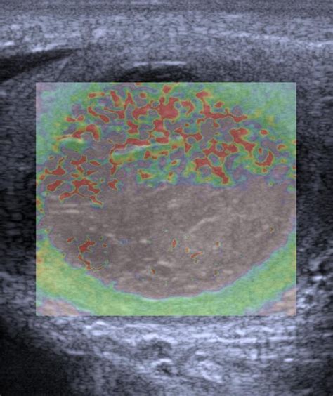 Epididymal Haematoma Multiparametric Ultrasonographic Findings Eurorad