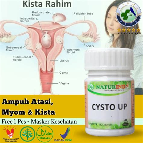 Jual Obat Herbal Miom Kista Ovarium Kista Coklat Kista Endometriosis